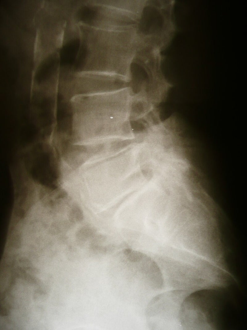 엑스레이만 보고 허리디스크를 진단할 수 있을까요? 디스크 간격·돌출·탈출과 MRI 검사 기준....