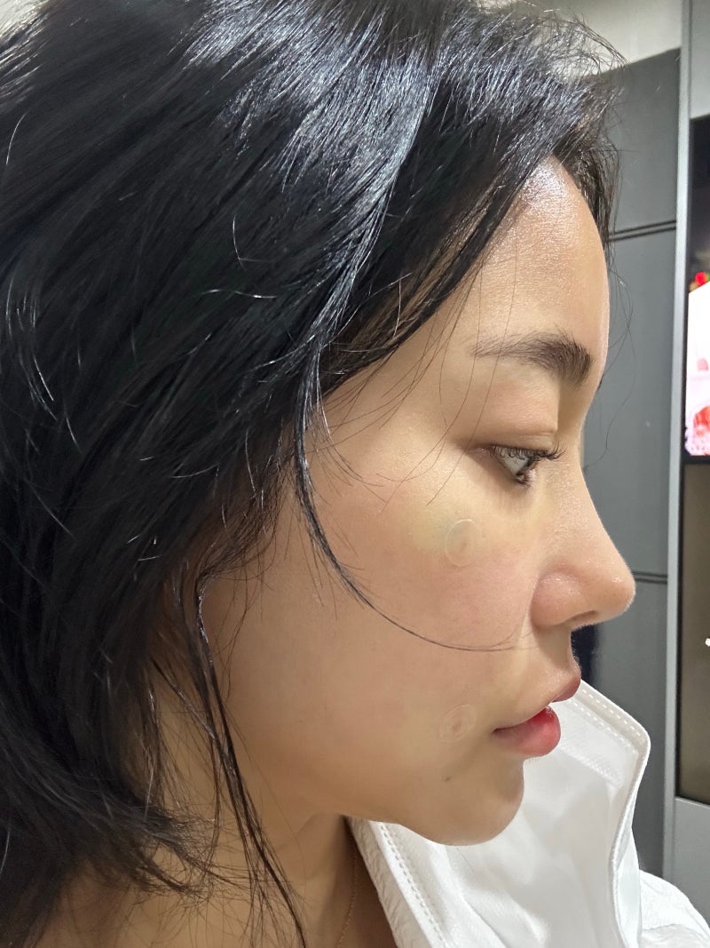 고우리 스킨부스터 홍대피부과 30대 눈밑 팔자 주름 관리 후기