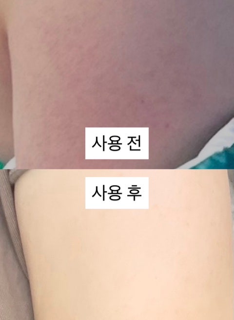 케라논연고 효과 좋은 모공각화증 홈케어 연고추천