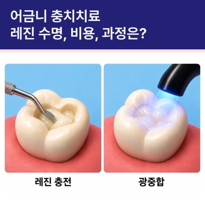 어금니 충치치료 레진 과정, 비용, 수명은?