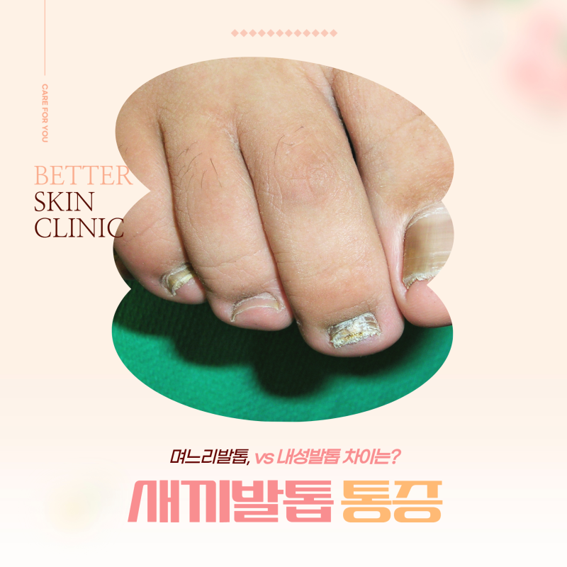 새끼발톱 통증 : 며느리발톱, 내성발톱 차이