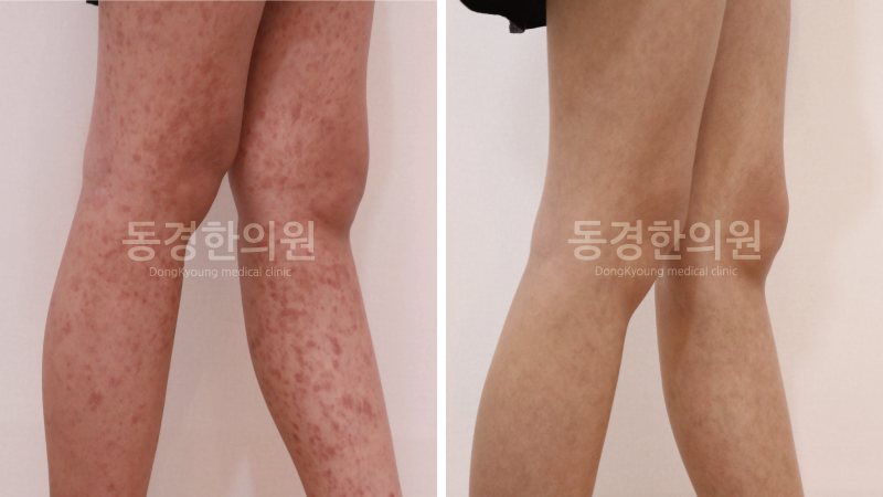 몸에 붉은 점, 다리 혈관염 증상과 치료방법