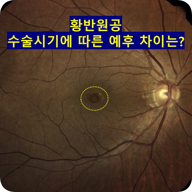 청주 안과 황반원공의 수술 시기에 따른 예후 차이는?