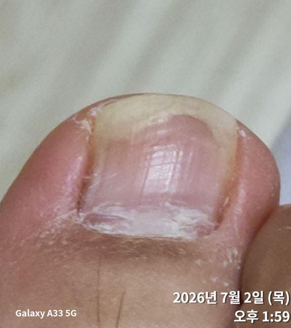 발톱무좀약 추천 완치과정