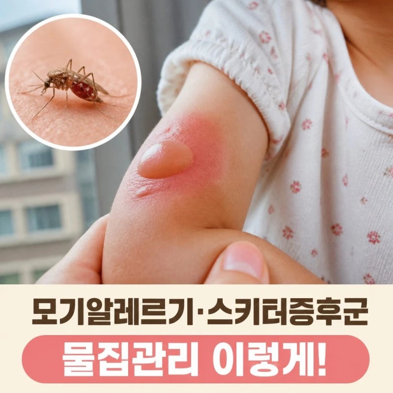 모기 물렸는데 물집이 생긴다면, 모기알레르기 스키터증후군 이렇게 관리해야만