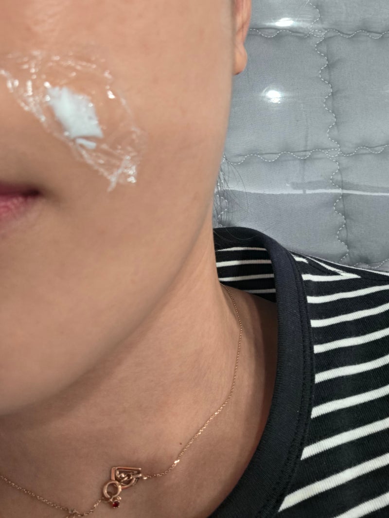 인천 구월동 패인흉터 쥬브젠으로 치료 후기｜동네 염증주사 후 생긴 흉터