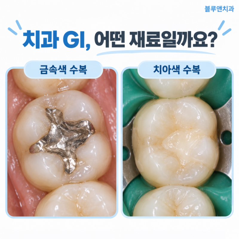 치과 GI, 충치치료 재료로 괜찮을까? 레진과 차이