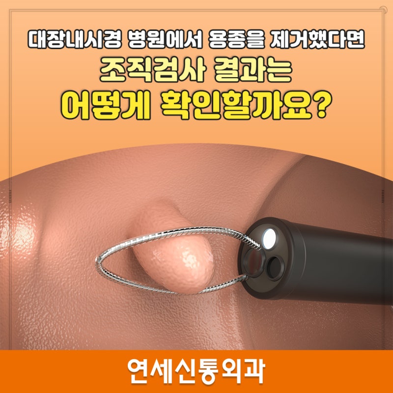 안양 대장내시경 병원에서 용종을 제거했다면 조직검사 결과는 어떻게 확인할까요?