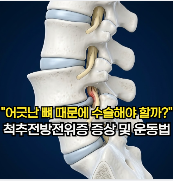 척추전방전위증, "어긋난 뼈 때문에 수술해야 할까?" 척추전방전위증 증상 및 운동
