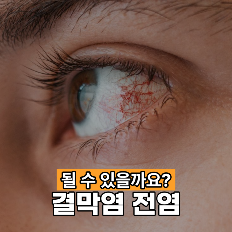 결막염 전염 될 수 있나요?