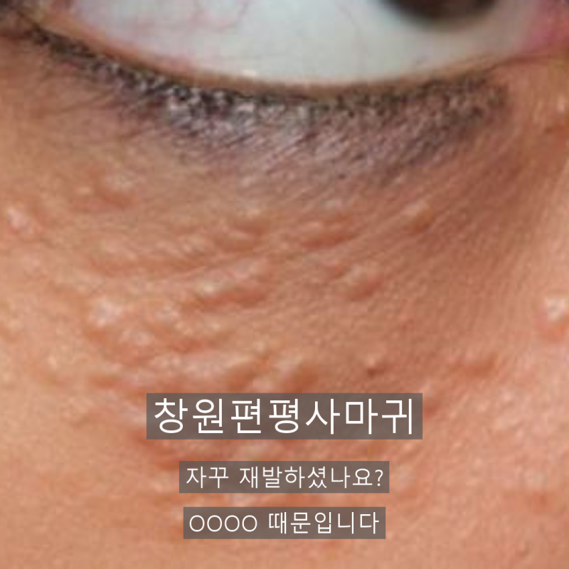 창원편평사마귀 자꾸 재발하셨나요? OOOO 때문입니다