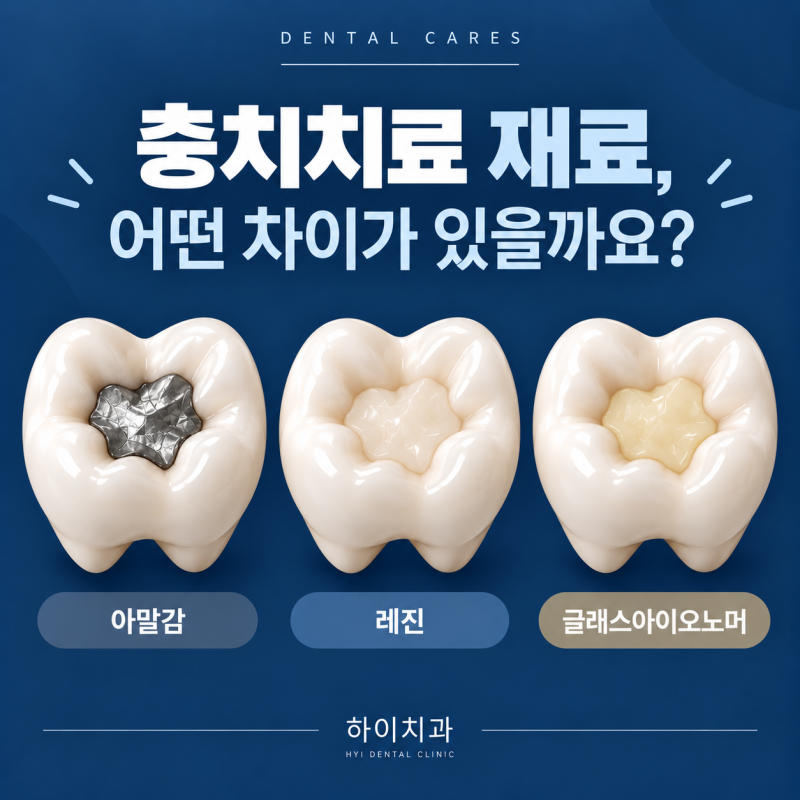 수완지구 치과, 충치치료할 때 레진만 있는 게 아니라고요?