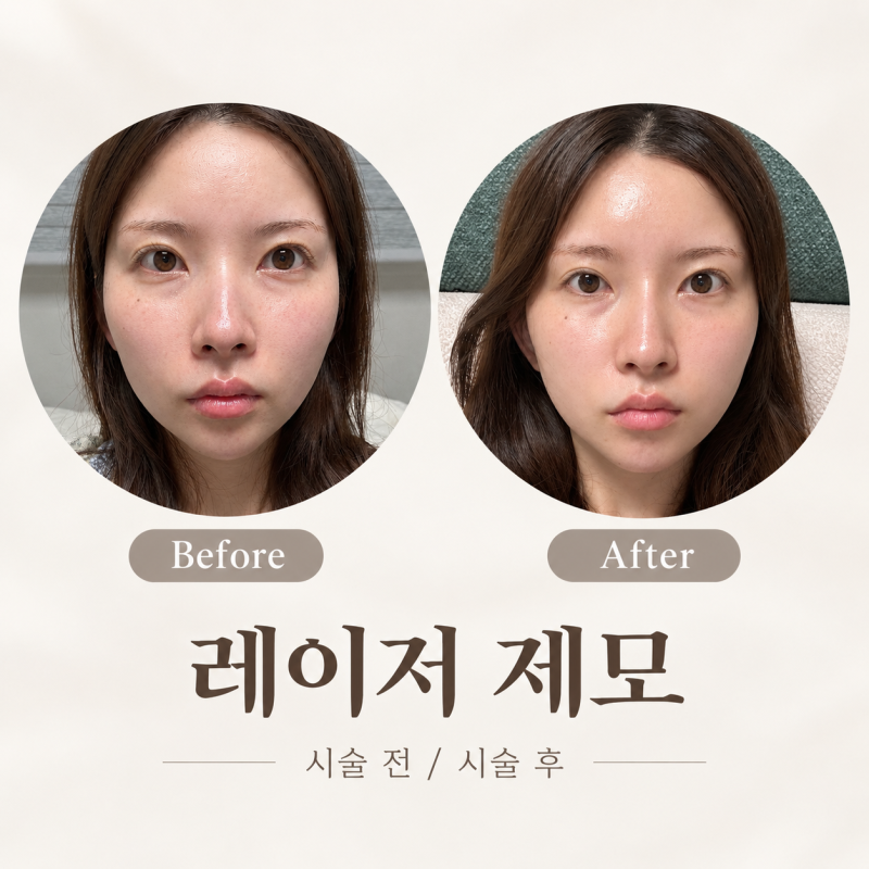 부산 젠틀맥스프로플러스 부산 레이저 제모 5회차｜직접 받아본 솔직한 후기