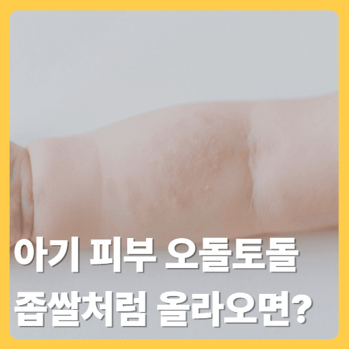 아기 피부 오돌토돌 좁쌀처럼 올라오는 이유: 번짐, 건조,비판텐 사용법
