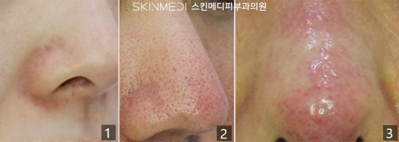 청담피부과 딸기코 치료_코 피지(블랙헤드), 넓은 모공, 빨간코, 여드름 치료법
