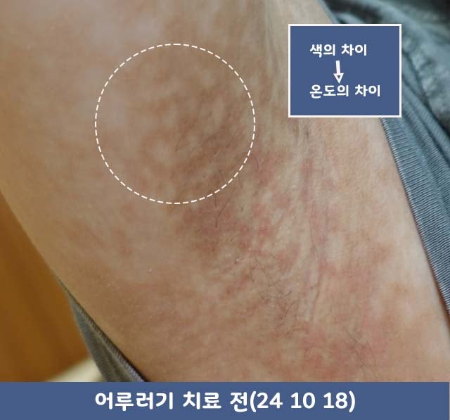어루러기, 얼룩덜룩한 찐 이유가 효모균?