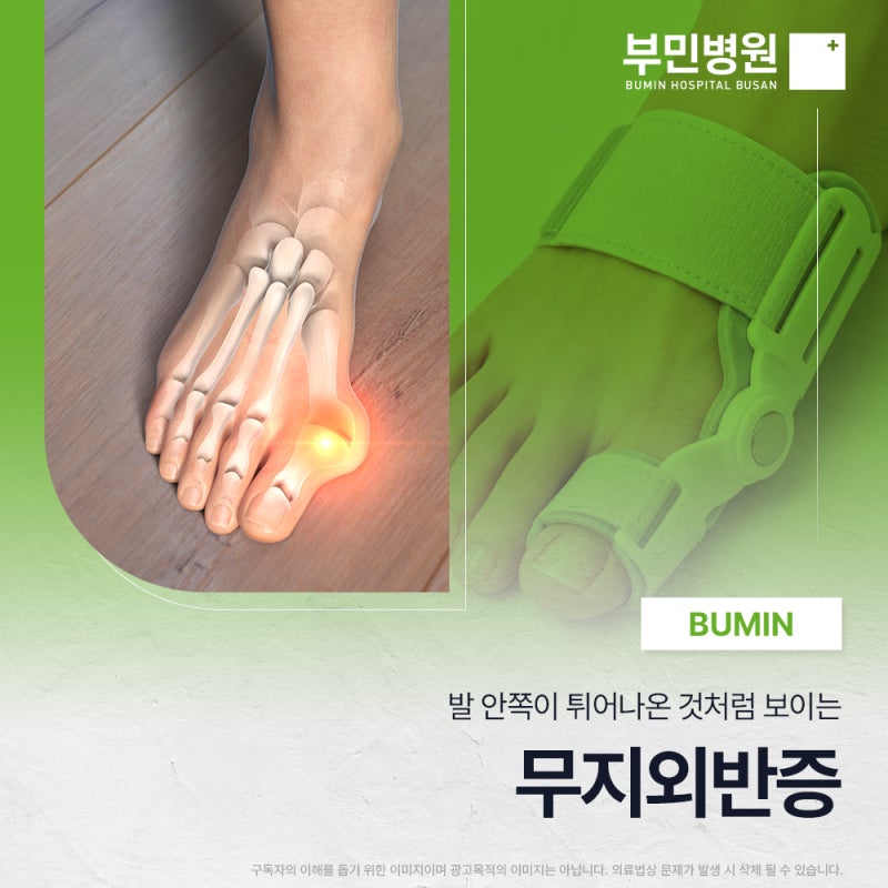 무지외반증치료방법 발가락 교정기, 어디까지 도움이 될까요?