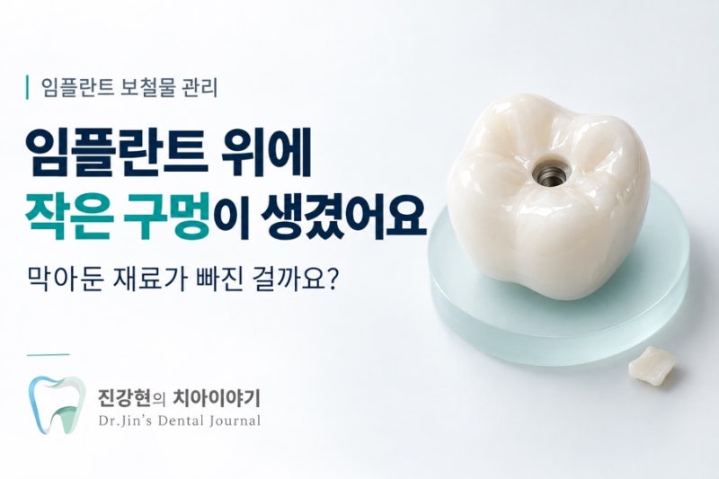 임플란트 나사 구멍을 막은 재료가 빠졌어요, 다시 막아야 할까요?