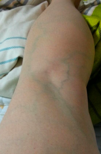 하지정맥류 실손보험, 입원하면 보험금 받을 수 있을까? 입원·통원 차이 총정리.1편