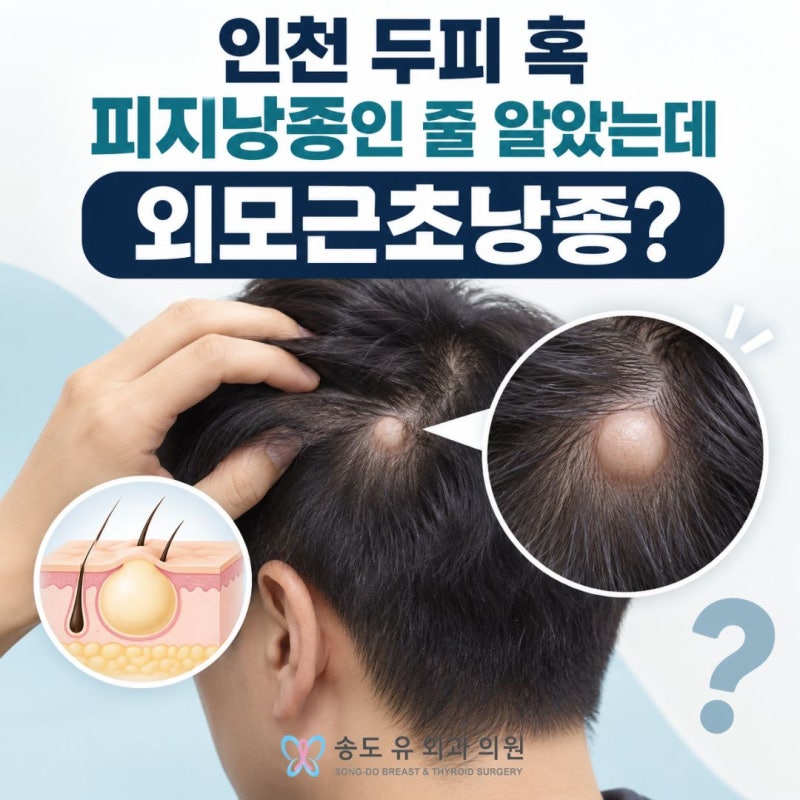 인천 두피 혹, 피지낭종인 줄 알았는데 외모근초낭종?
