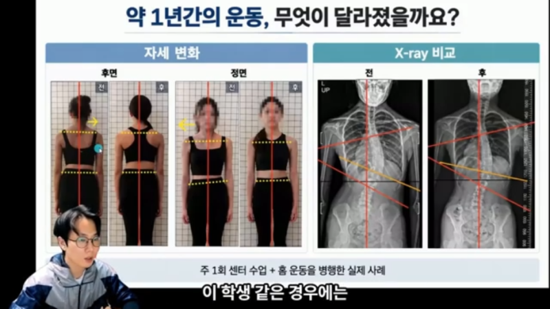척추측만증 교정운동 1년, 실제로 얼마나 달라졌을까?