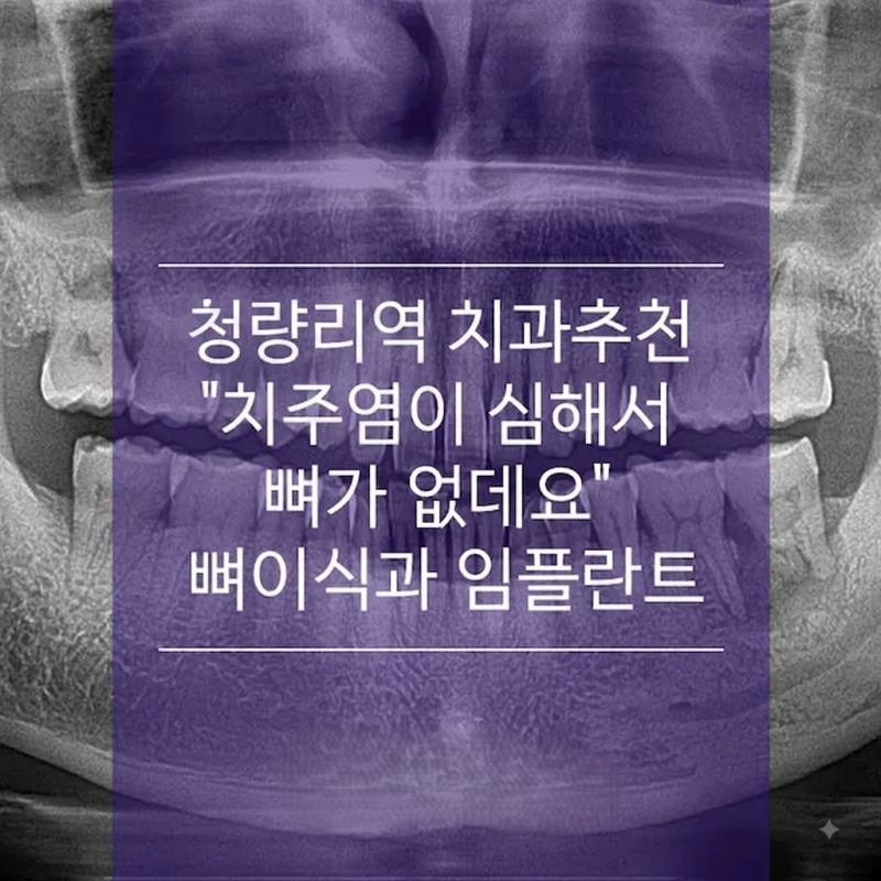 청량리 임플란트 수면치과 | 임플란트 잇몸뼈이식만 하면 안 되나요? 잇몸 소실의 비밀과 해....