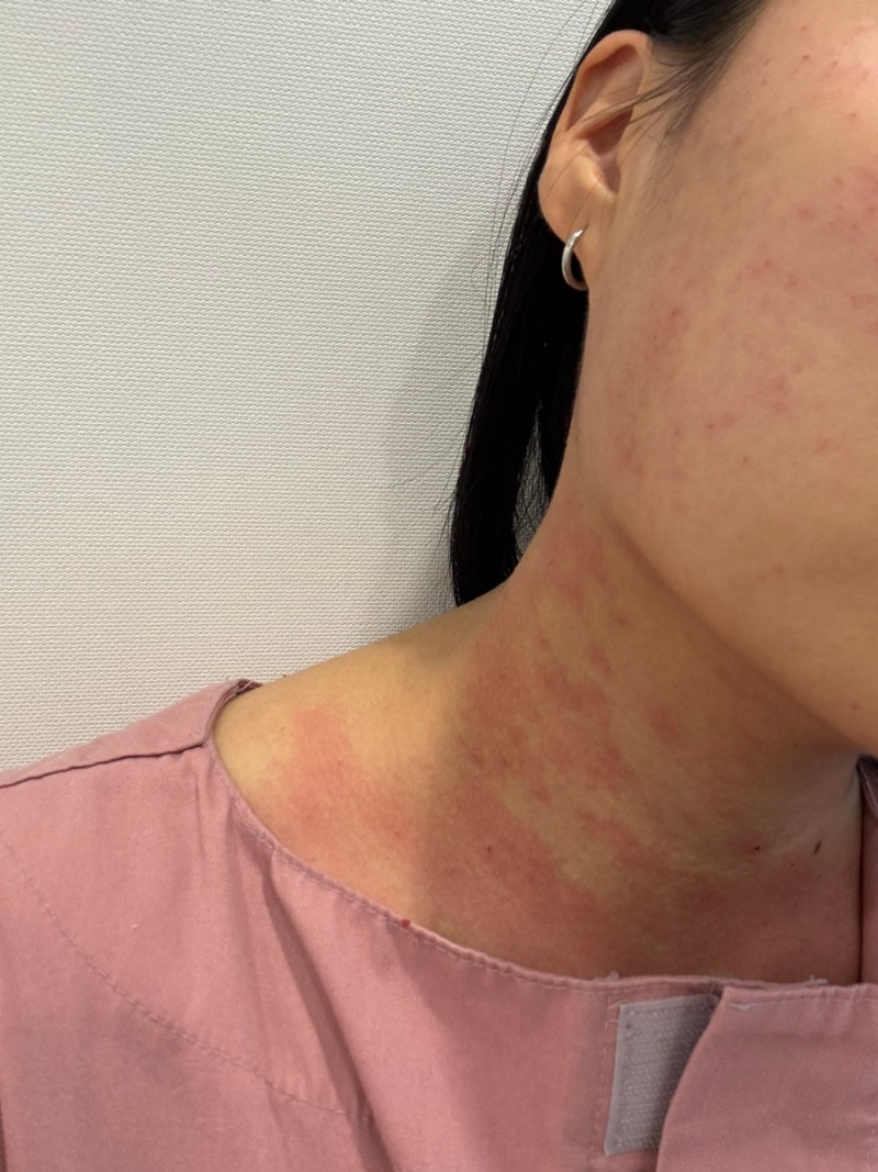 수원편평사마귀제거 성지 얼굴+목 무제한 제거 후기