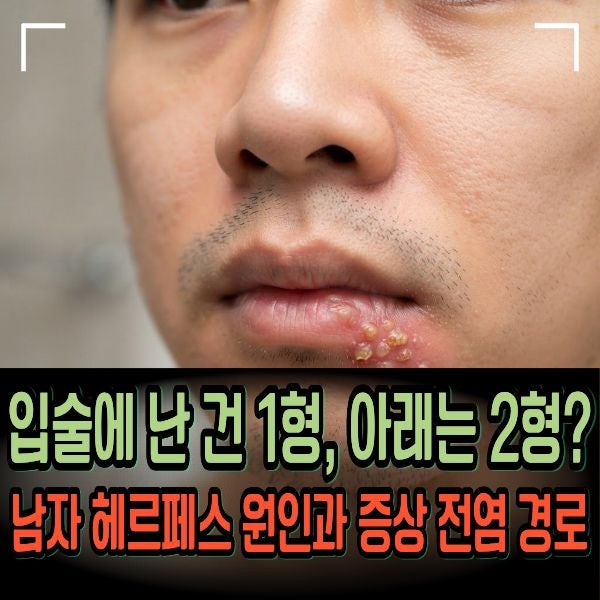 입술에 난 건 1형, 아래는 2형? 남자 헤르페스 원인과 증상 전염 경로