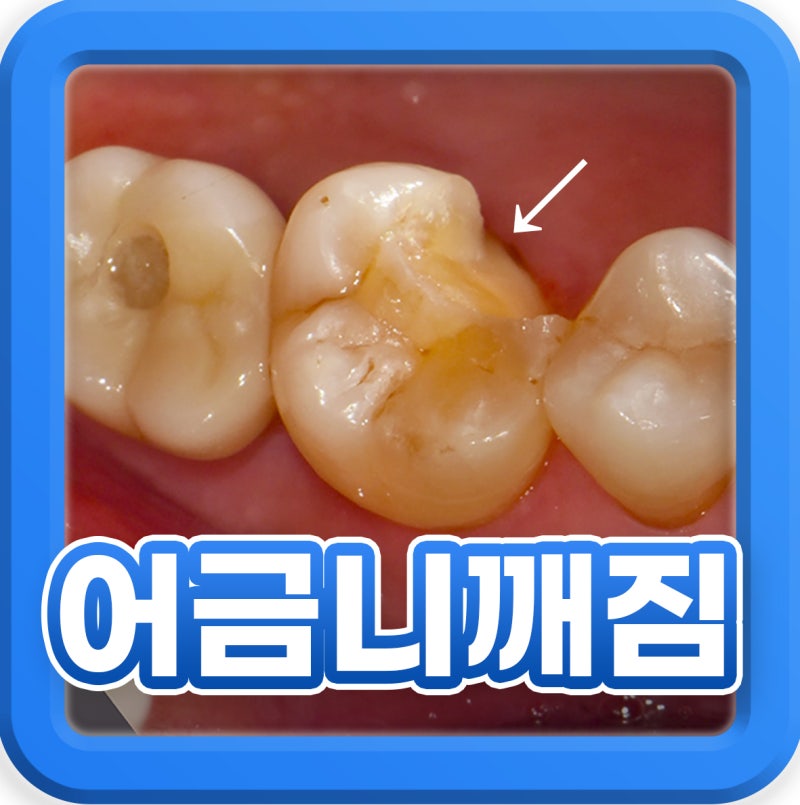 동삼동치과 충치 어금니 깨짐 시린 통증 느껴질 때 인레이?