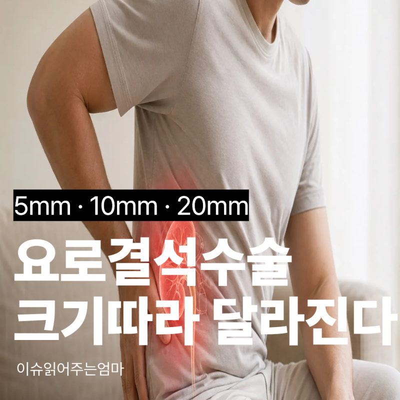 요로결석 수술, 5mm·10mm·20mm 크기에 따라 달라집니다