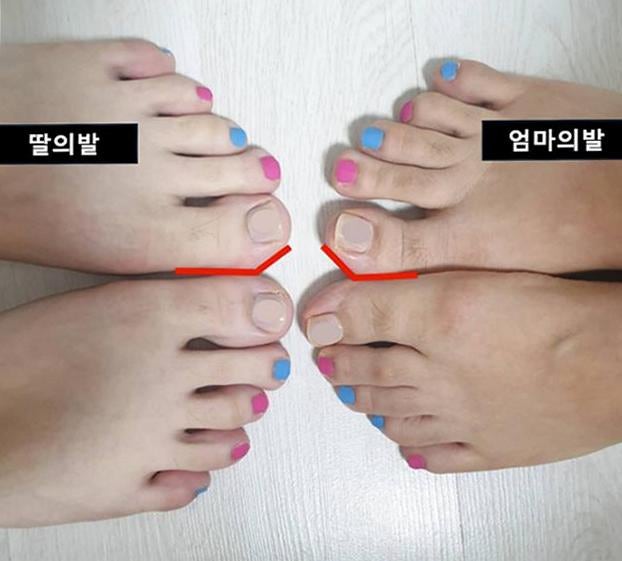 무지외반증 각도 단계 넷과 단계별 신발 조건