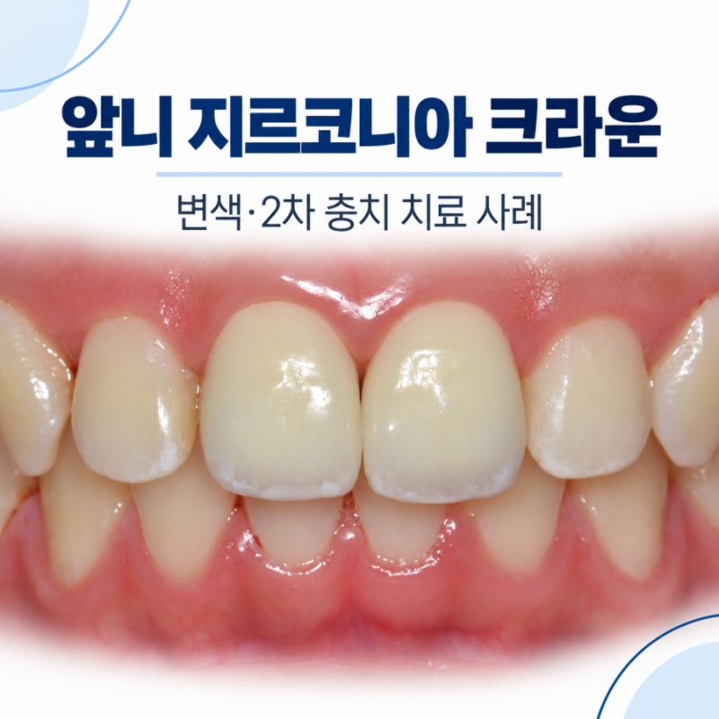 앞니충치 치료 후 변색됐다면? 지르코니아크라운 치료사례