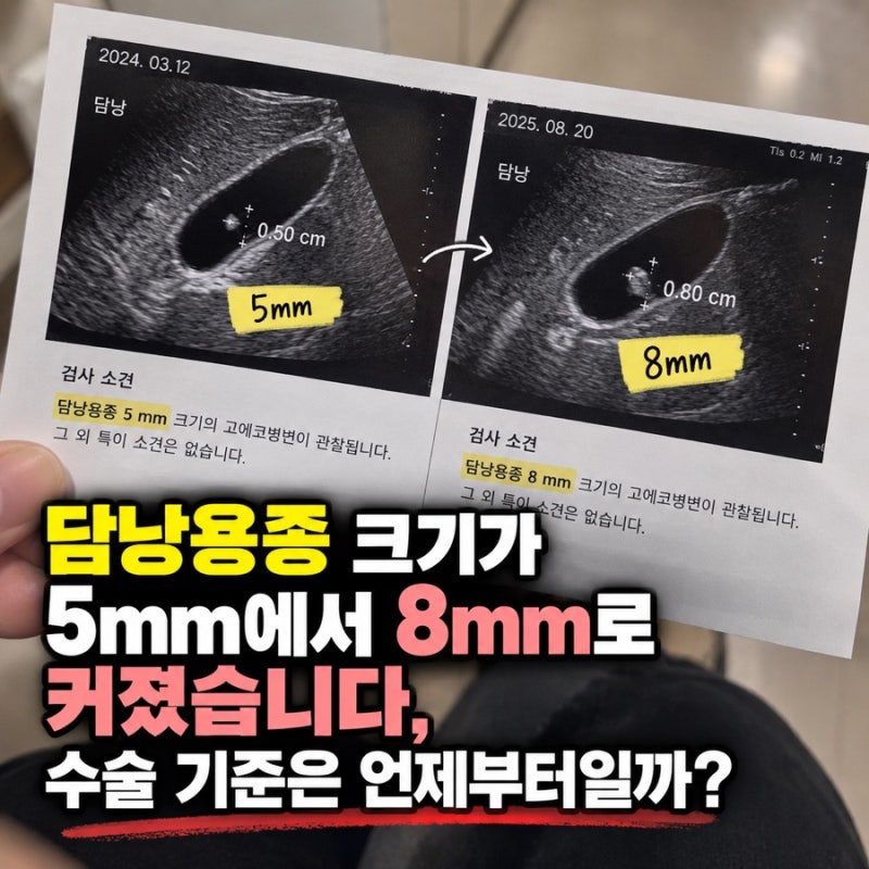담낭용종 크기가 5mm에서 8mm로 커졌습니다, 수술 기준은 언제부터일까