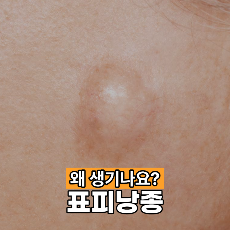 표피낭종 왜 생기나요?
