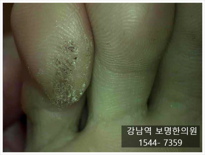 발바닥사마귀 원인과 증상, 티눈과 구분하고 재발 관리까지
