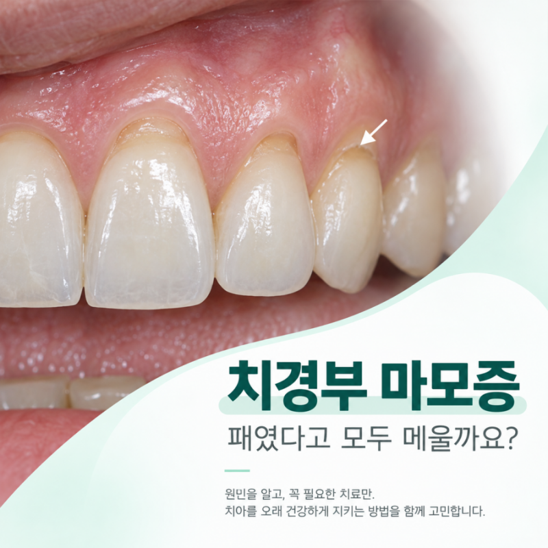 치경부마모증, 잇몸 치아 패이는 이유와 치료 기준