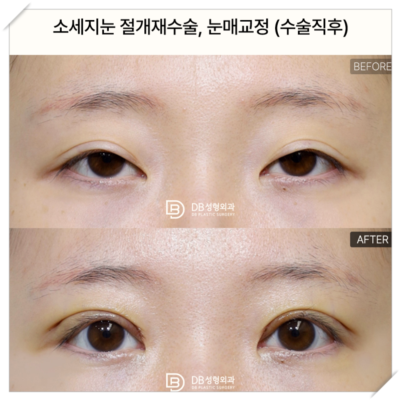 쌍꺼풀재수술비용, 눈 재수술 전 피부 여분이 없는 눈이라면?