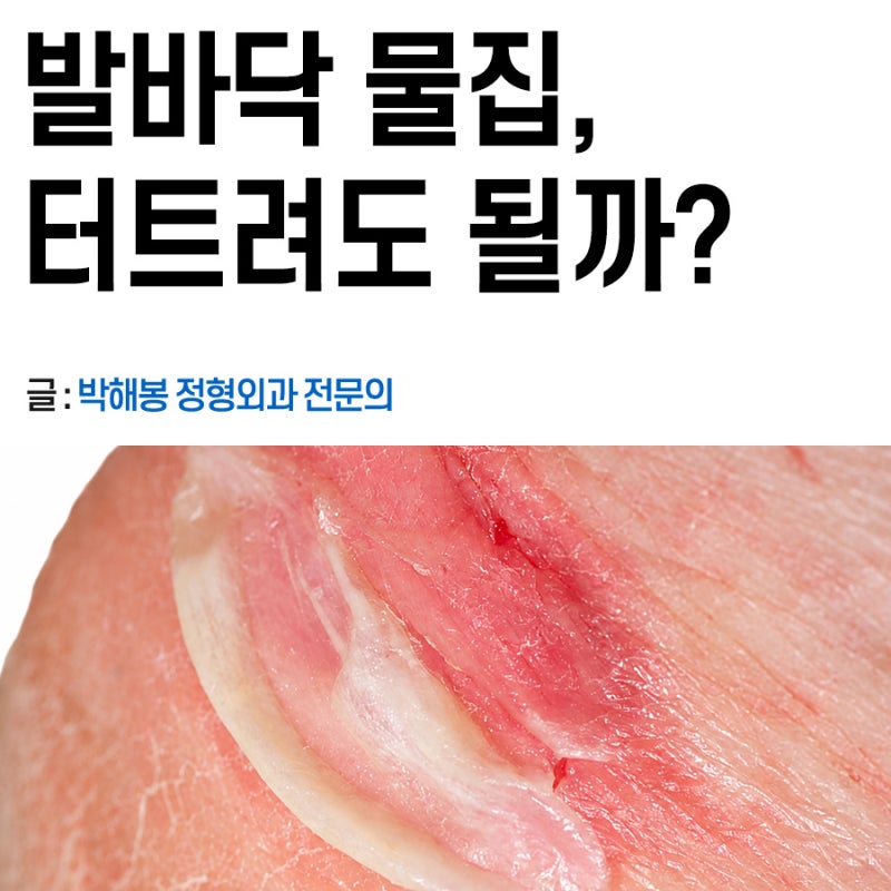 발바닥물집 생겼을때(터졌을때), 밴드(듀오덤) 병원