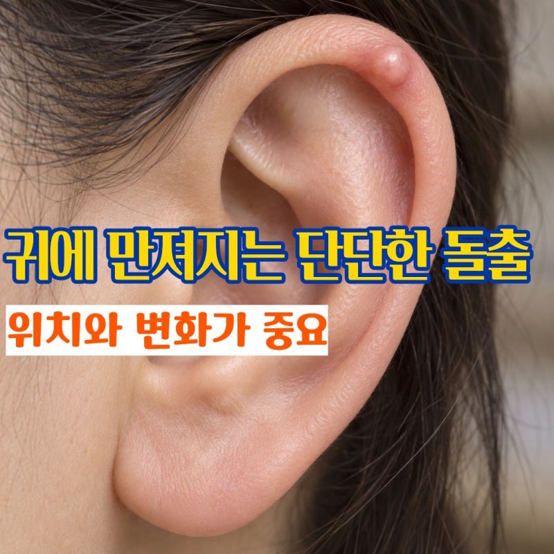 귀살튀 귀에혹처럼 단단하게 만져지는 귀연골통증 원인