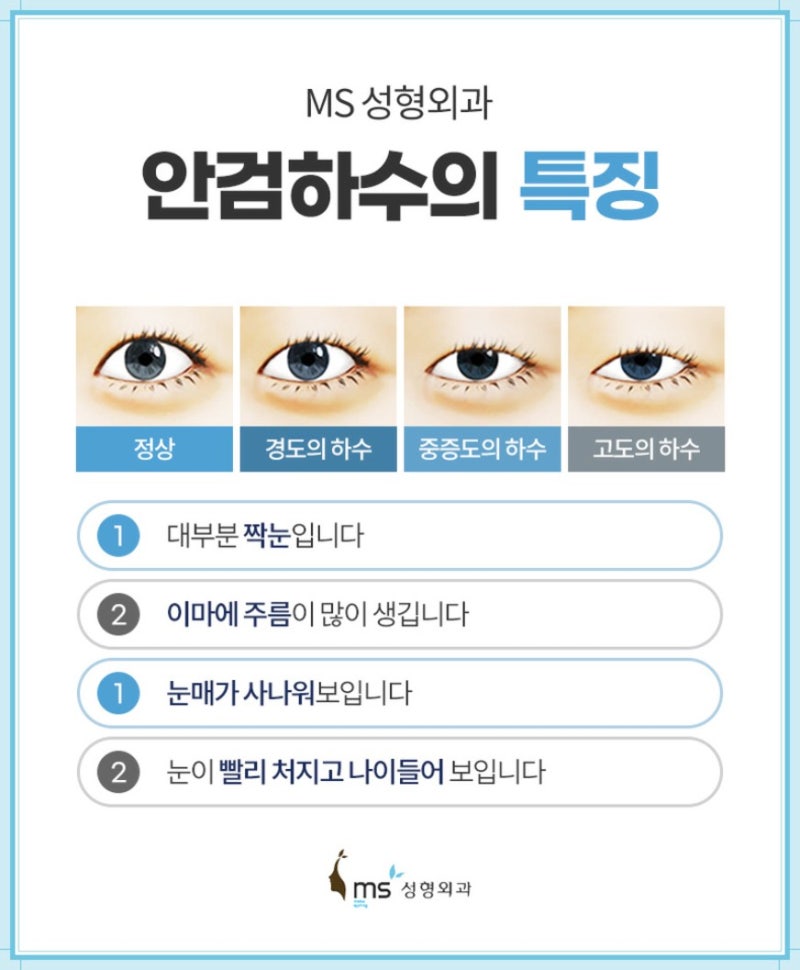 무쌍눈매교정술, 쌍꺼풀 없이 또렷한 눈매를 만들 수 있을까요?