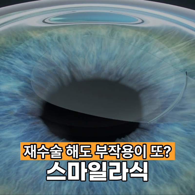 스마일라식 부작용으로 재수술하면 부작용이 또 생길 수 있나요?