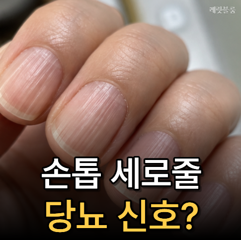 "손톱 세로줄 당뇨 신호?" 손톱에 세로줄 생기는 진짜 이유