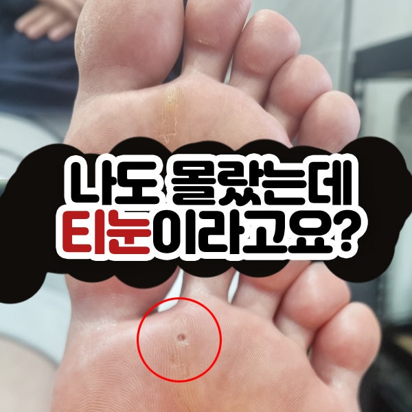 광주 티눈 제거 전 필수 확인! 굳은살과 차이점 및 관리 과정 가이드