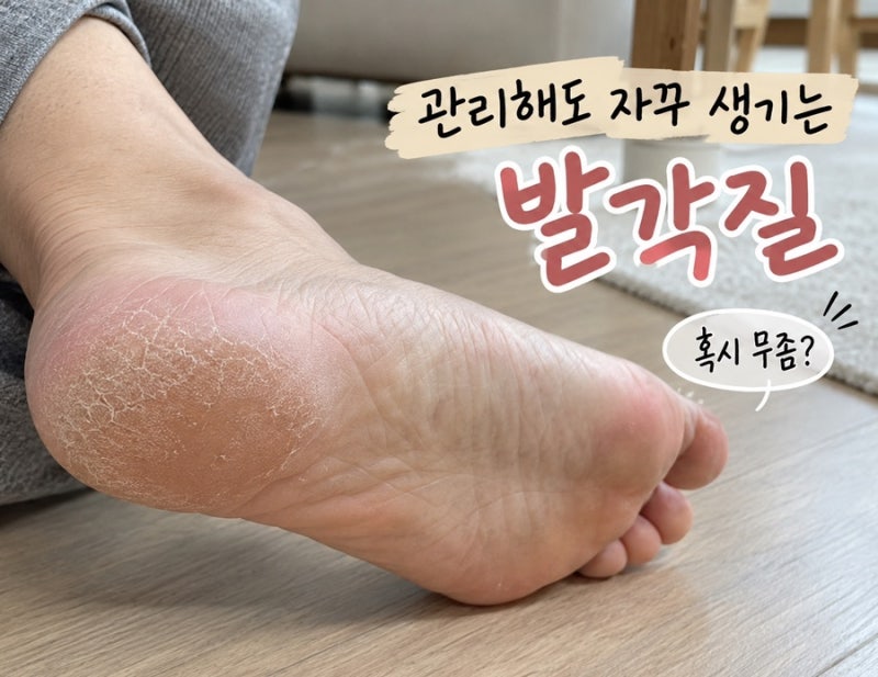 발뒤꿈치 각질 무좀일까? 관리해도 자꾸 생긴다면
