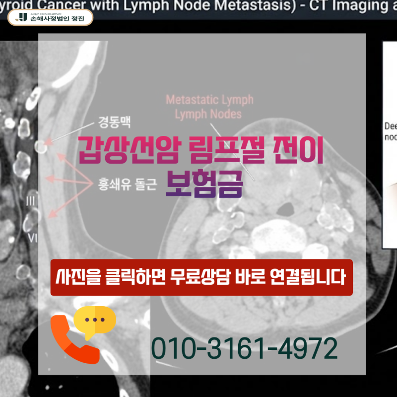 갑상선암 림프절 전이 보험금, C73·C77 진단서 받고도 소액암에 그치셨나요?