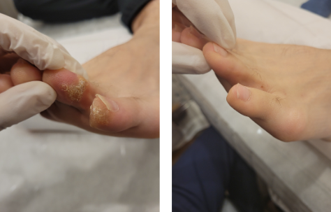 연고 끊으면 바로 무좀 재발한다면, 치료를 바꿔야 하는 기준 3가지