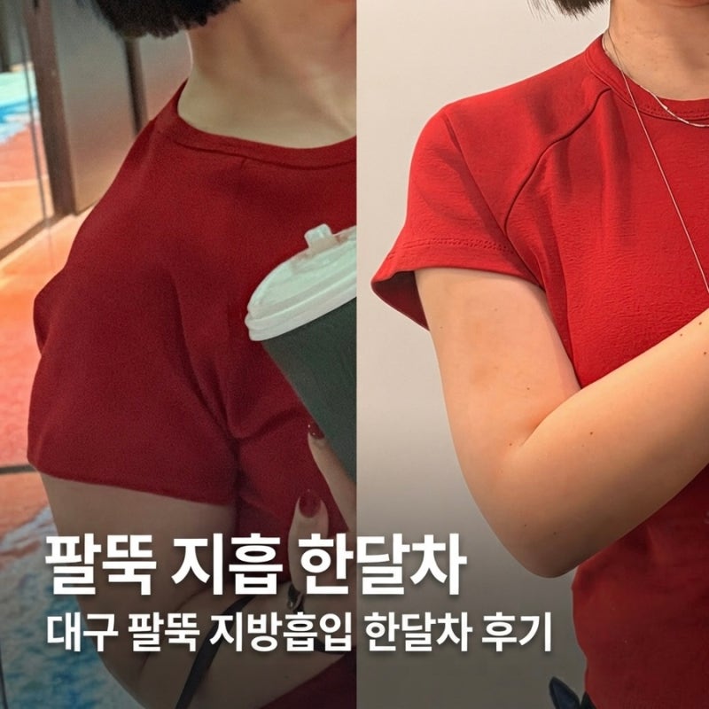 대구팔뚝지방흡입 한달차 코끼리팔뚝 탈출 후기 2탄