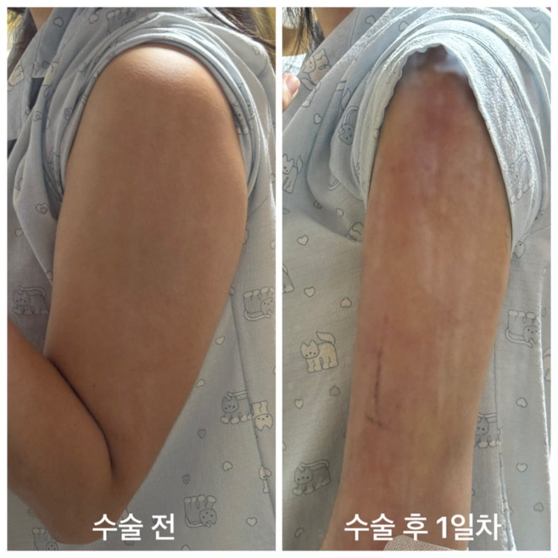 [14.일기리뷰] 팔뚝 지방흡입 1일차 지흡 후기, 변화, 통증, 멍, 붓기, 흉터, 후관리 (1탄)