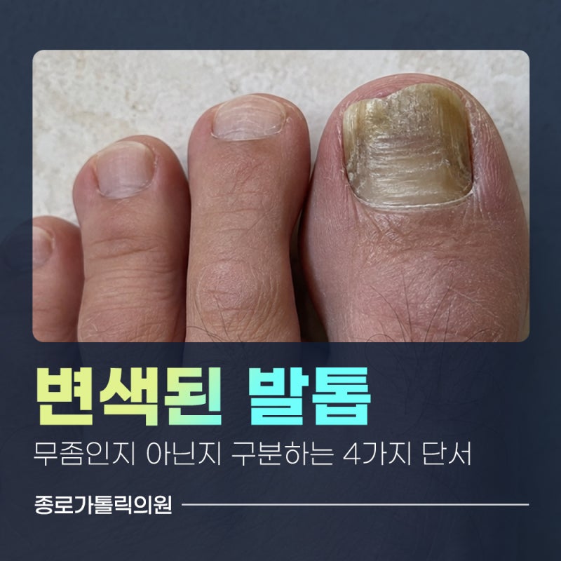 종로3가 변색된 발톱, 무좀인지 아닌지 구분하는 4가지 단서