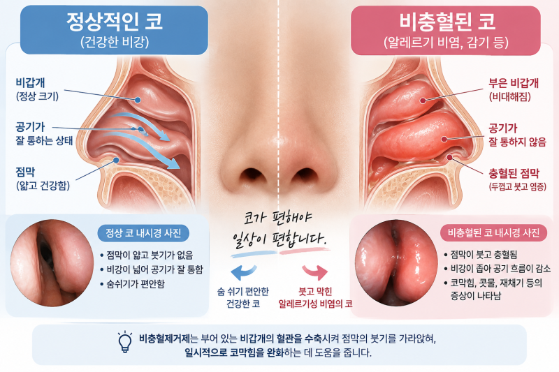 코막힘 스프레이, 오래 쓰면 안 되는 이유?